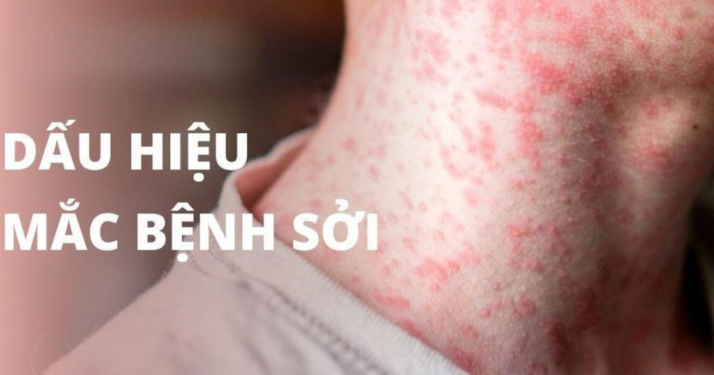 Sởi tấn công, gây tử vong ở người lớn